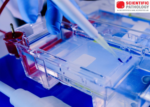 Protein Electrophoresis | Private Lab For Covid -19 Testing – Scientificpathology.com