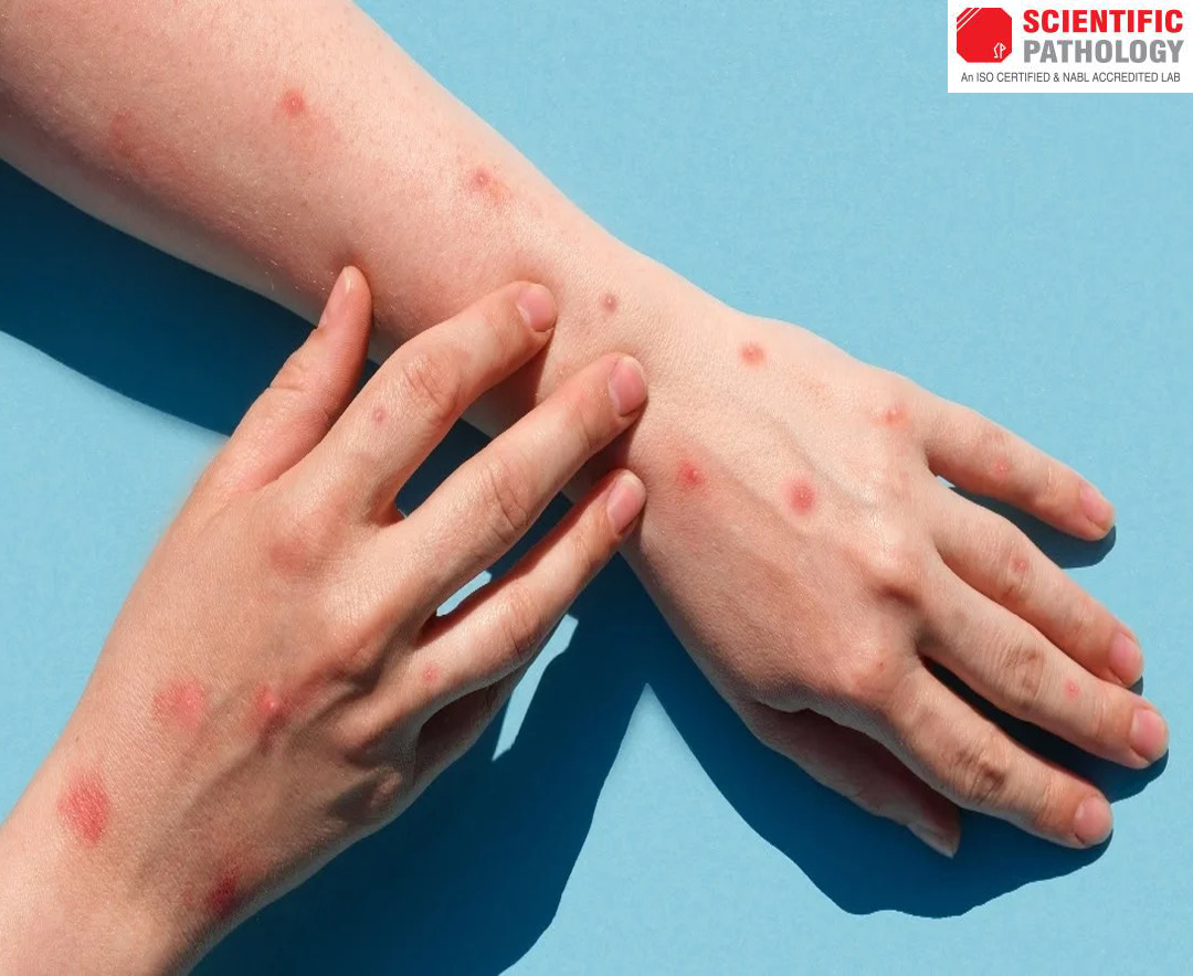 What is Monkey Pox & How to Spot it?